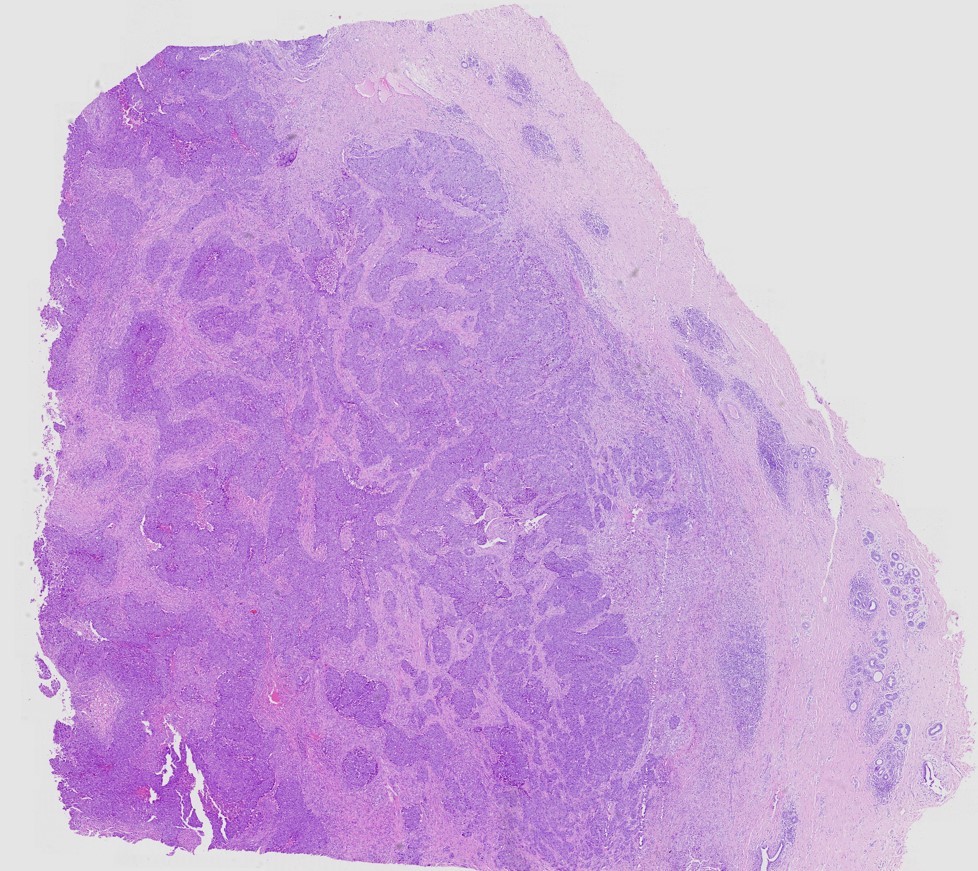Breast carcinoma-08-20x