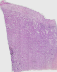 Lung cancer