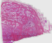 Prostate Cancer