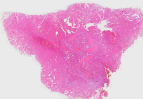 Thyroid cancer