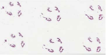 Duodenal